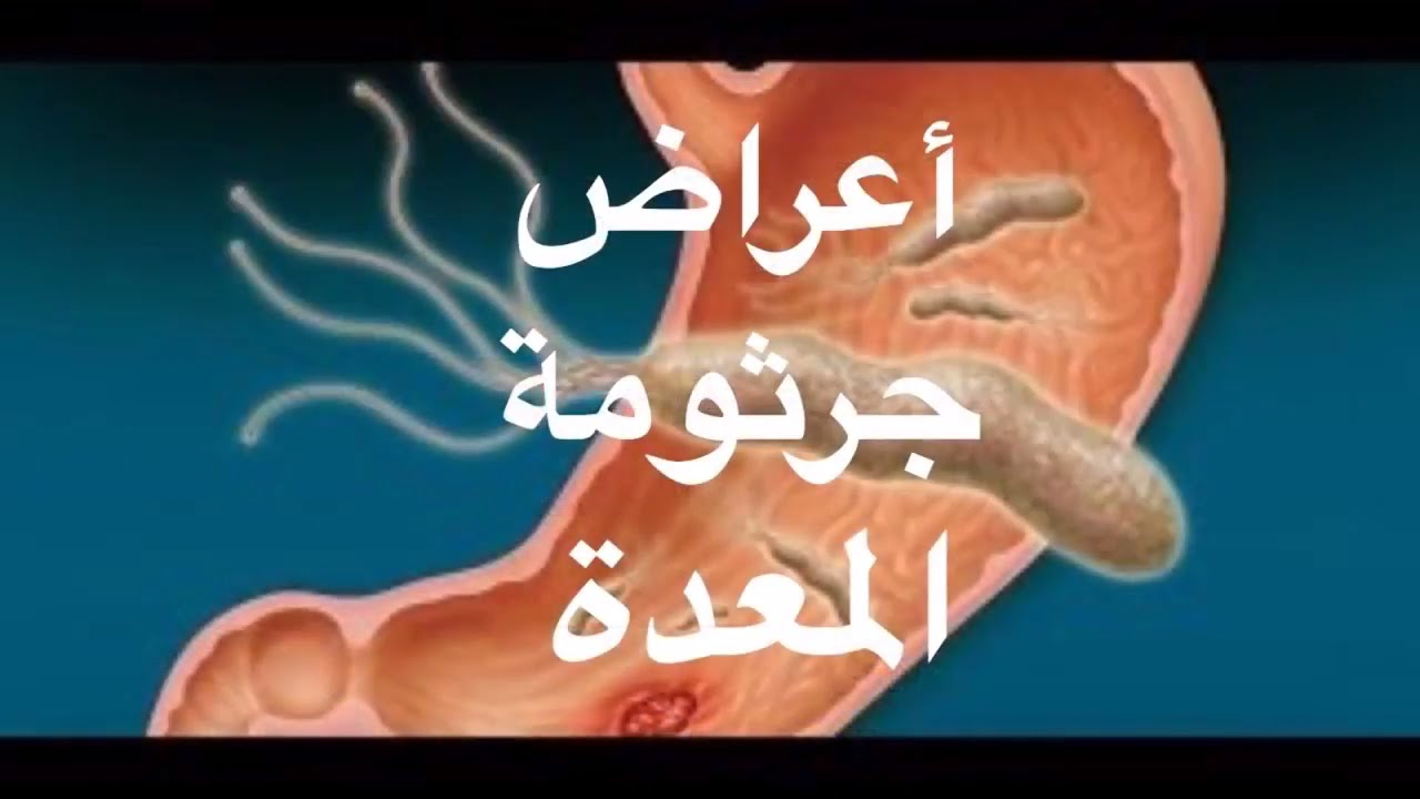 اعراض الميكروب الحلزونى 10696 3