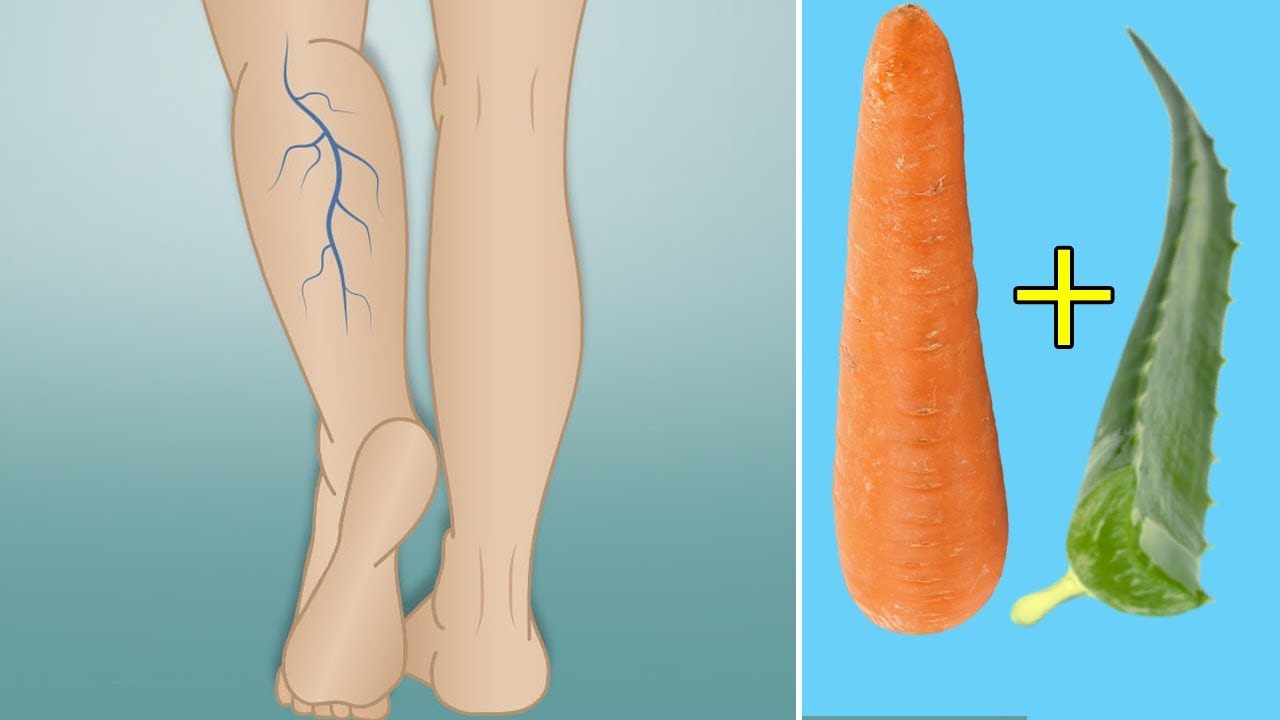 علاج الدوالي , طريقة فعالة لعلاج دوالي الساقين