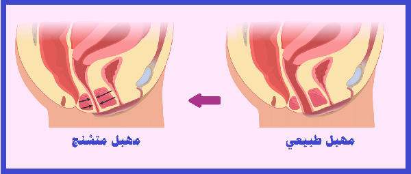ضيق فتحة المهبل - تعرف علي علاج ضيق المهبل 10527 1