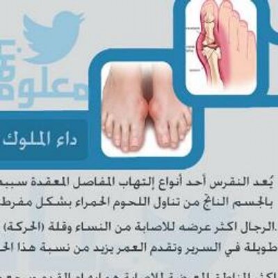 علاج النقرس - تعرف على كيفية علاج مرض النقرس 3973