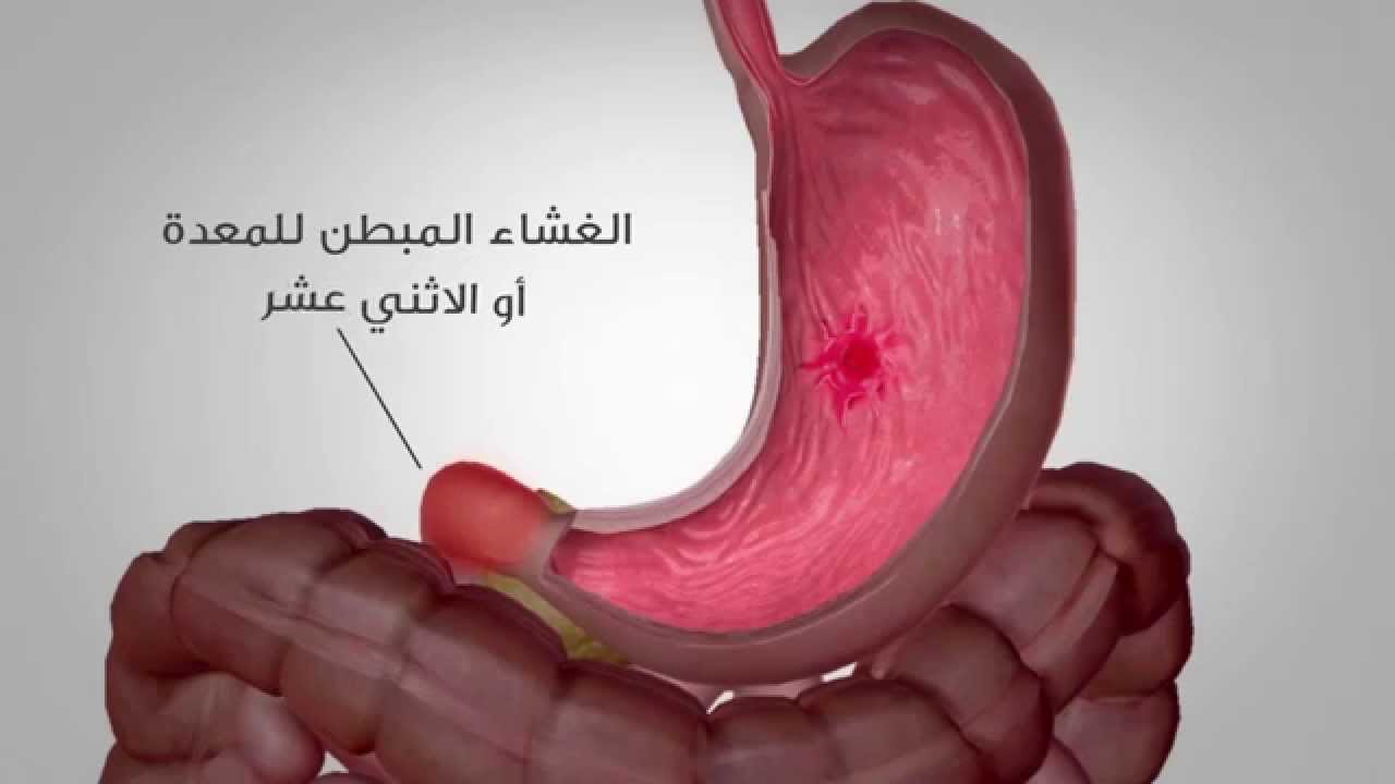 اعراض قرحة المعدة , تعرف علي مرض قرحة المعدة وطريقة علاجة