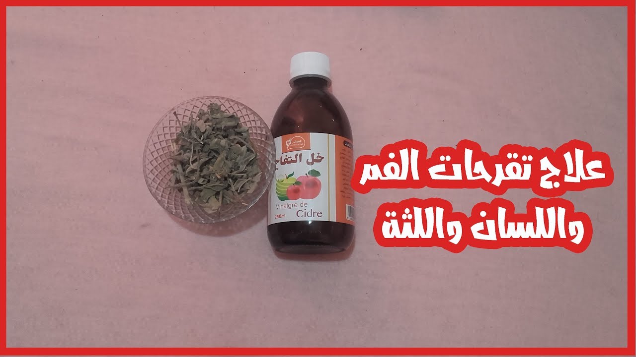 علاج تقرحات اللسان 10577 3