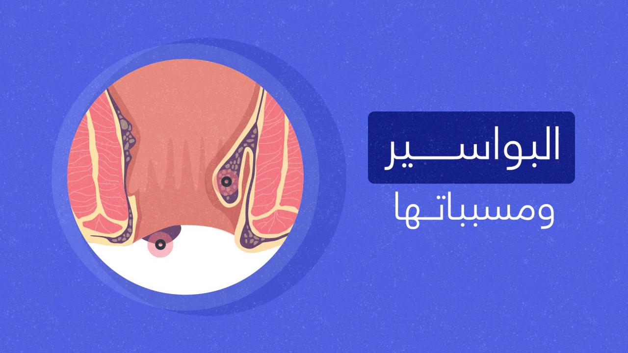 مرض البواسير - تعرف على اهم الاعراض المميزة لتشخيص البواسير 937 2