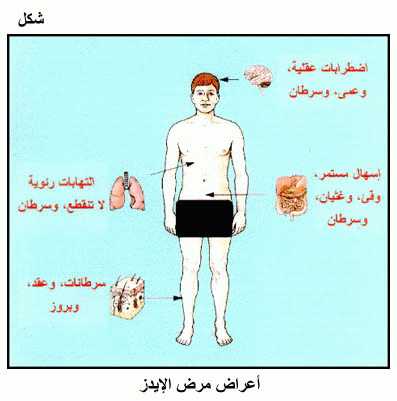 اعراض الايدز , تعرف على اهم اعراض مرض الايدز