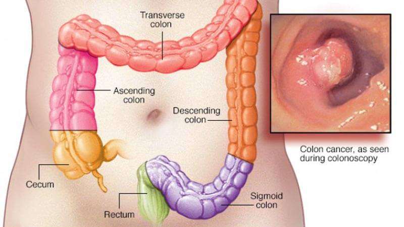 اعراض سرطان القولون - السرطان مرض خطير يهدد حياة الجميع 1746 1