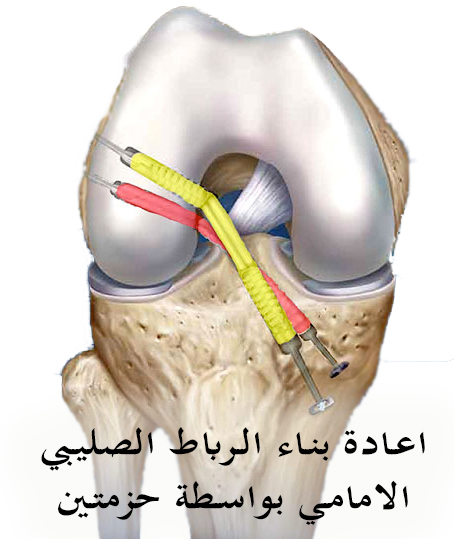 عملية الرباط الصليبي