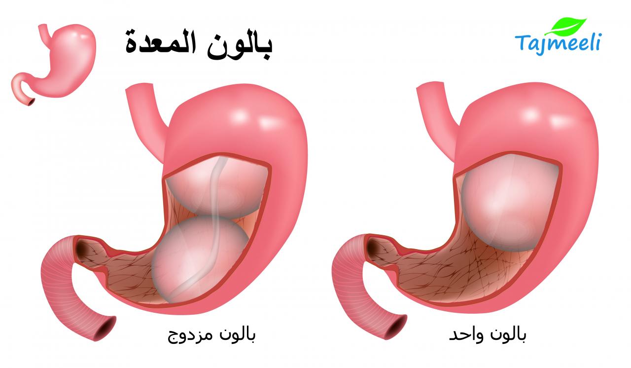 كبسولة بالون المعدة الجديدة لتخسيس الوزن