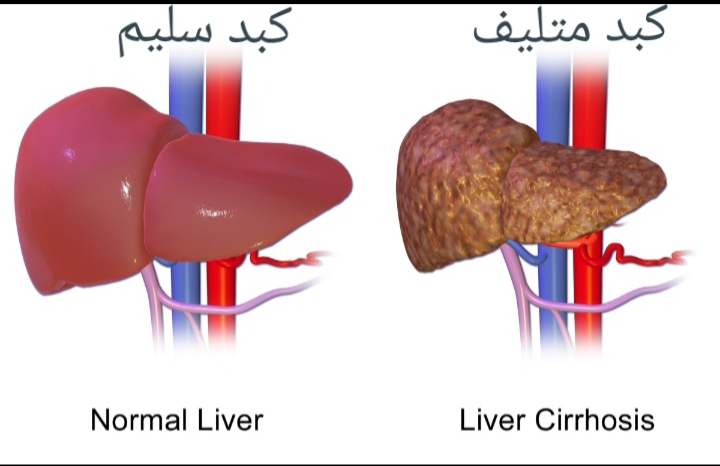 اسباب مرض فيروس سي - فيروس سي اسبابه واعراضه 10350 2