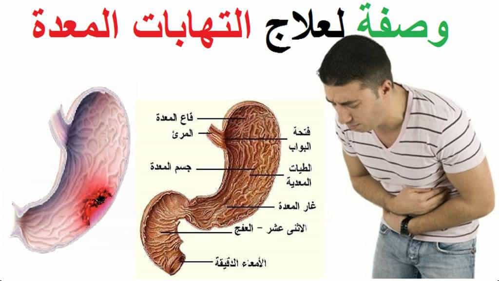 علاج التهاب المعدة والامعاء , وصفات طبيعية لعلاج التهاب المعدة والامعاء