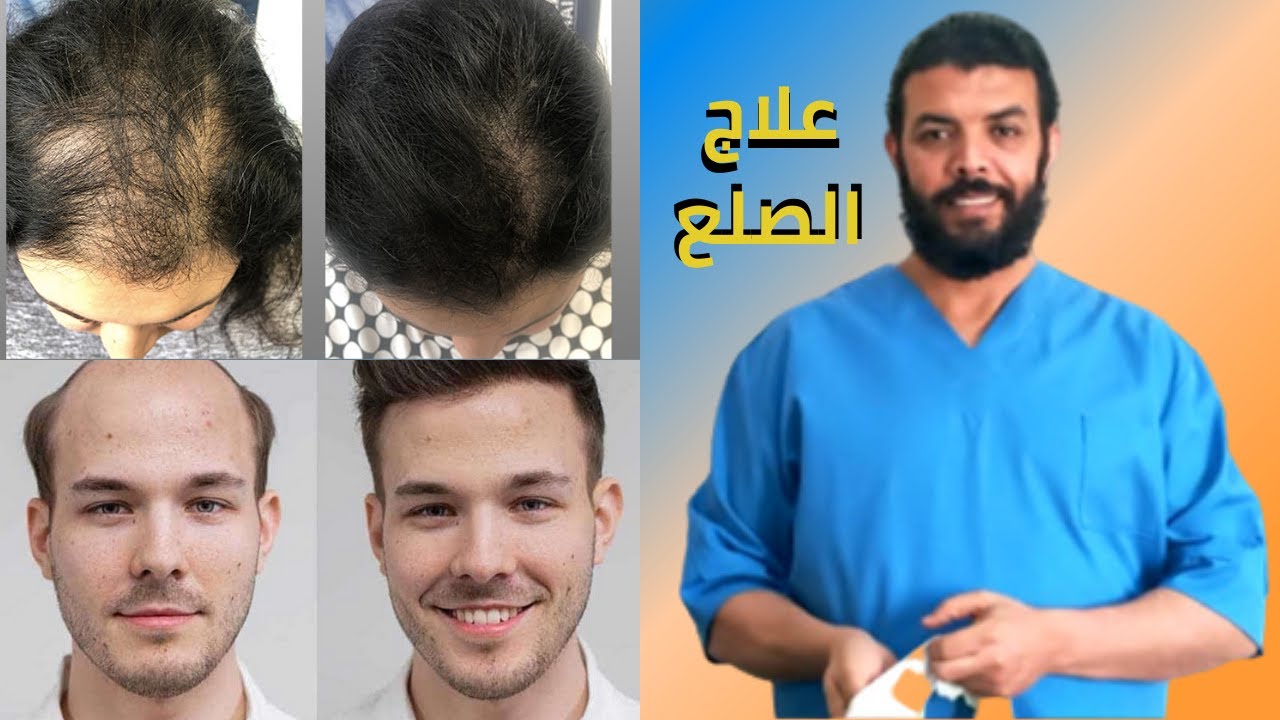 ما هو الصلع وعلاجه السريع والفعال-علاج الصلع الوراثي 4404 2