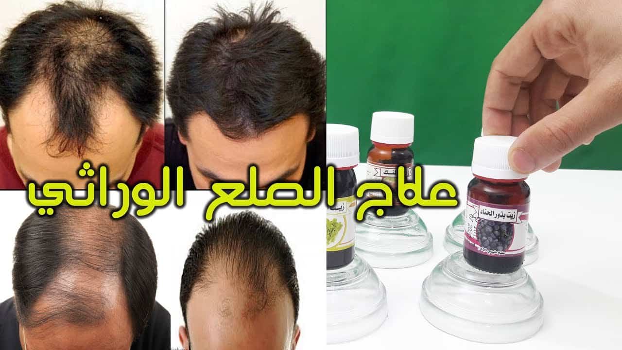 ما هو الصلع وعلاجه السريع والفعال-علاج الصلع الوراثي 4404