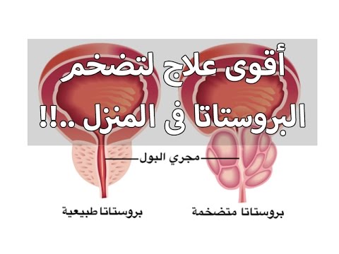 علاج تضخم البروستاتا - تعالو بنا نتعرف علي طرق علاج تضخم البروستاتا 106 3