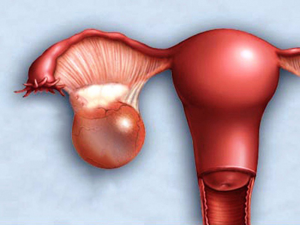 وجود كيس في الرحم - اسباب وجود كيس فى الرحم 10074 6