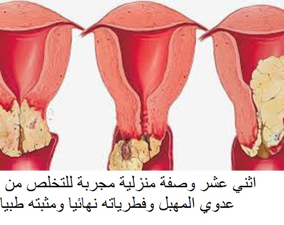 ضيق فتحة المهبل - تعرف علي علاج ضيق المهبل 10527 2