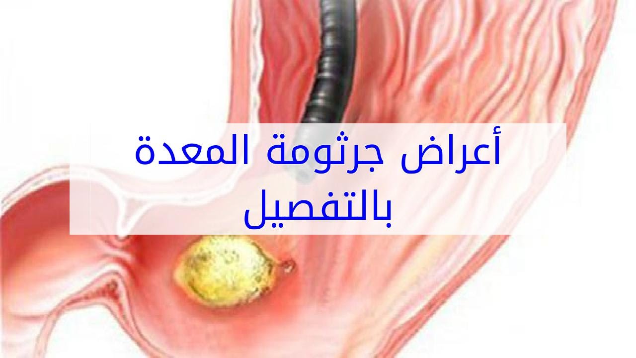 جرثومة المعدة اعراض , اسباب واعراض جرثومة المعدة