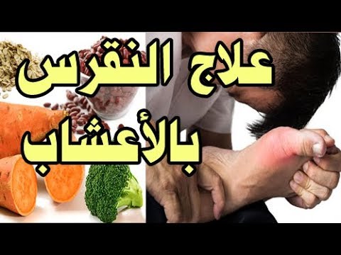 علاج النقرس بالاعشاب - النقرس والجديد في علاجه واكتشافات الطب البديل 6226 5