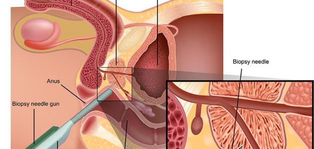 مرض البروستات - انواع الاصابه بالبروستاتا تفصيلا 4220 2