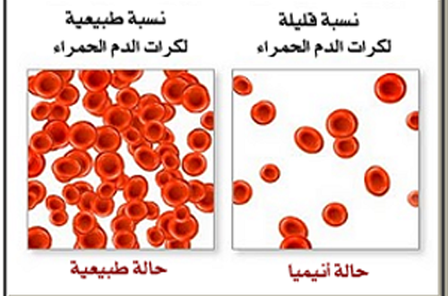 مرض فقر الدم - اعراض فقر الدم 2518