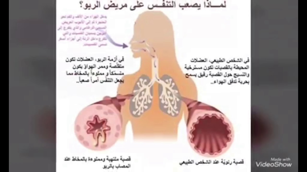 مرض الربو - معلومات هامة عن مرض الربو