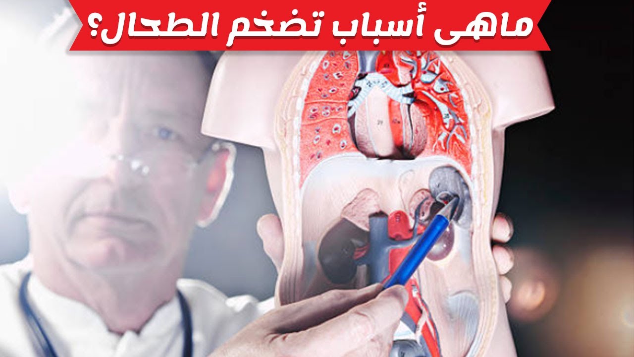 تضخم الطحال , تعرف على اسباب مهمة لتضخم الطحال ومضاعفاته