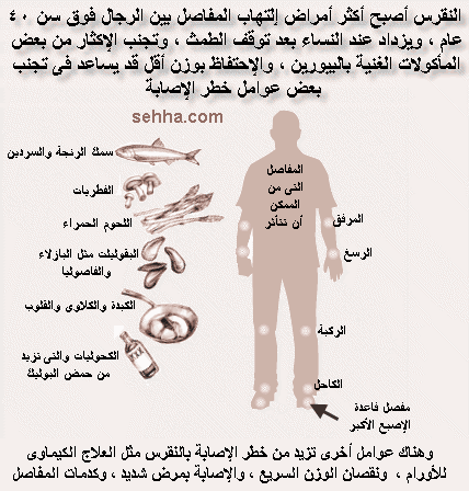 علاج النقرس - تعرف على كيفية علاج مرض النقرس 3973