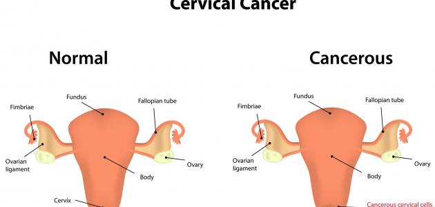 اعراض سرطان الرحم - اهم ما تعرفية عن سرطان الرحم 3439 11