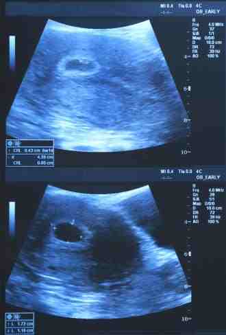 علامات الحمل بتوأم في الشهر الاول