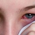 3669 3 علاج الرمد - كيفية علاج مرض رمد العين خاطرة نسيم