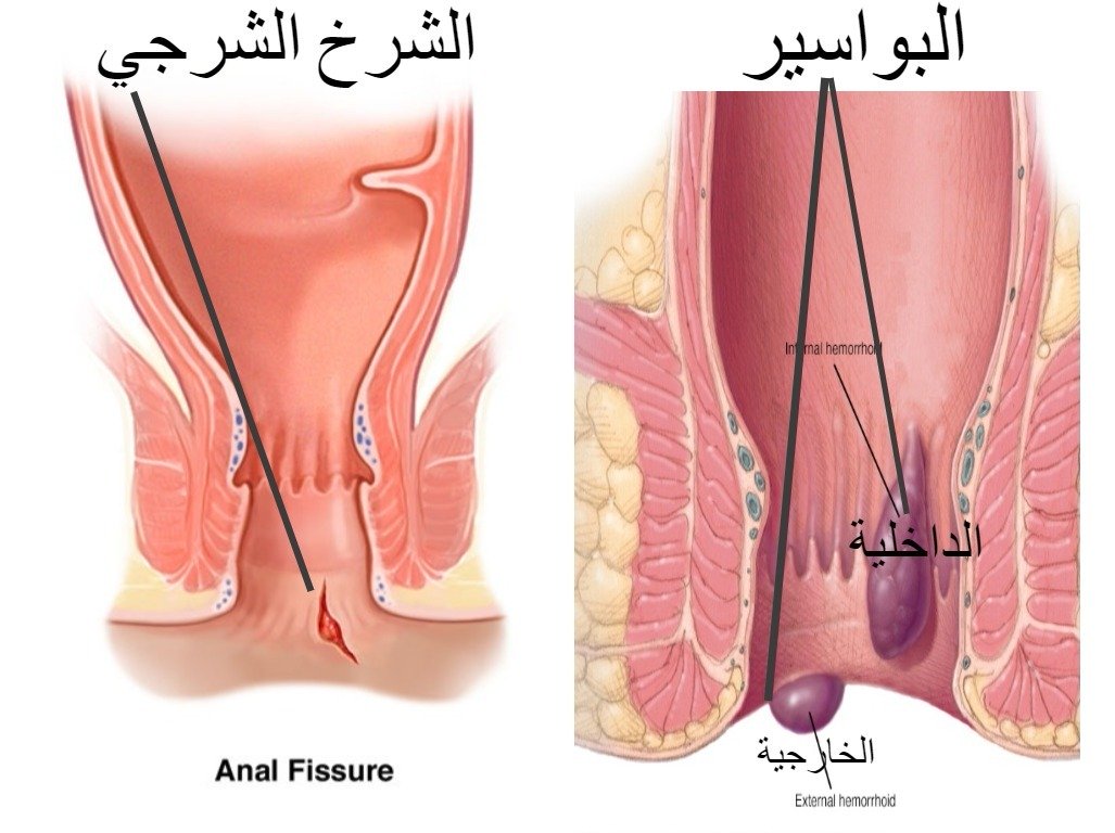 كيف شكل البواسير , تعرف على شكل البواسير لديك