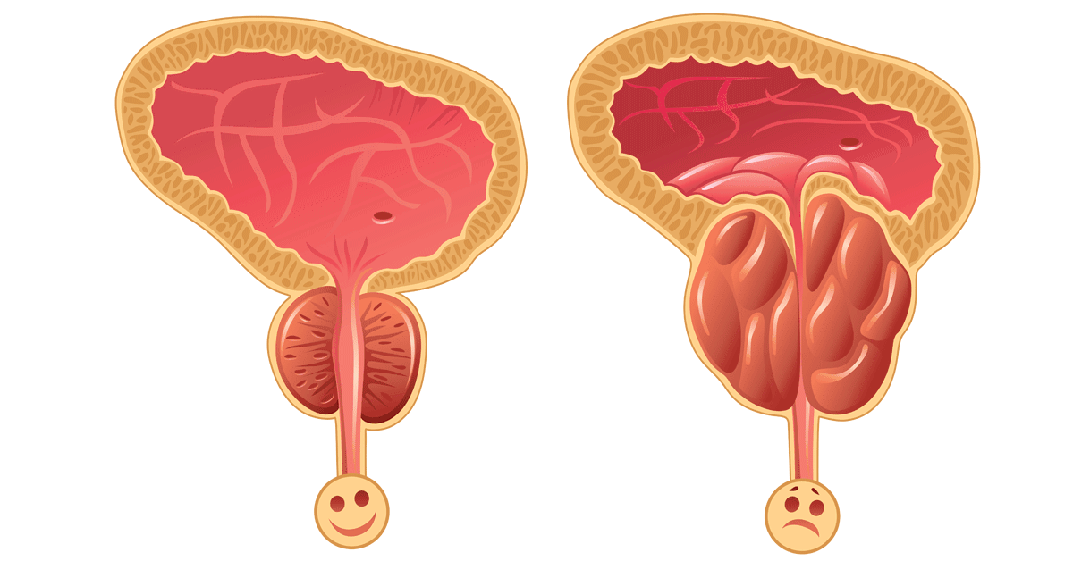 اسباب تضخم البروستاتا - تعرف على اعراض تضخم البروستاتا و كيفية الوقاية منها