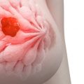 1412 1 اعراض سرطان الثدي رائفة غزلان